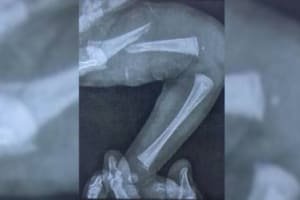Bebê de 9 dias fratura o fêmur durante teste do pezinho, em Aparecida