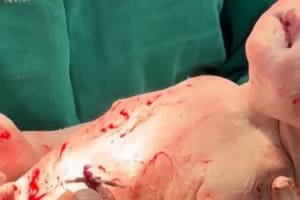 Bebê nasce com DIU na mão em Nerópolis