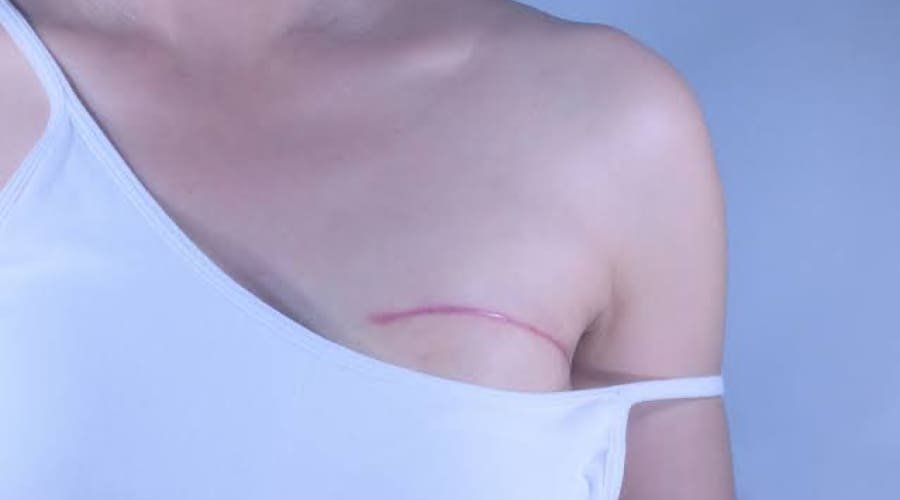 Cirurgia reparadora das mamas passa a ser garantida pelo SUS em qualquer situação