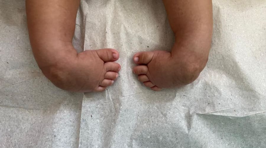 Cirurgias corrigem “pé torto” e mudam a vida de crianças em Aparecida