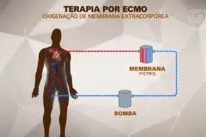 MC Marcinho usa terapia conhecida como ECMO, espécie de pulmão artificial; entenda como funciona