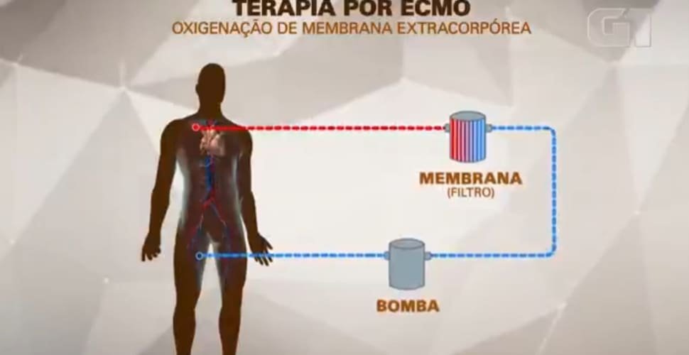 MC Marcinho usa terapia conhecida como ECMO, espécie de pulmão artificial; entenda como funciona