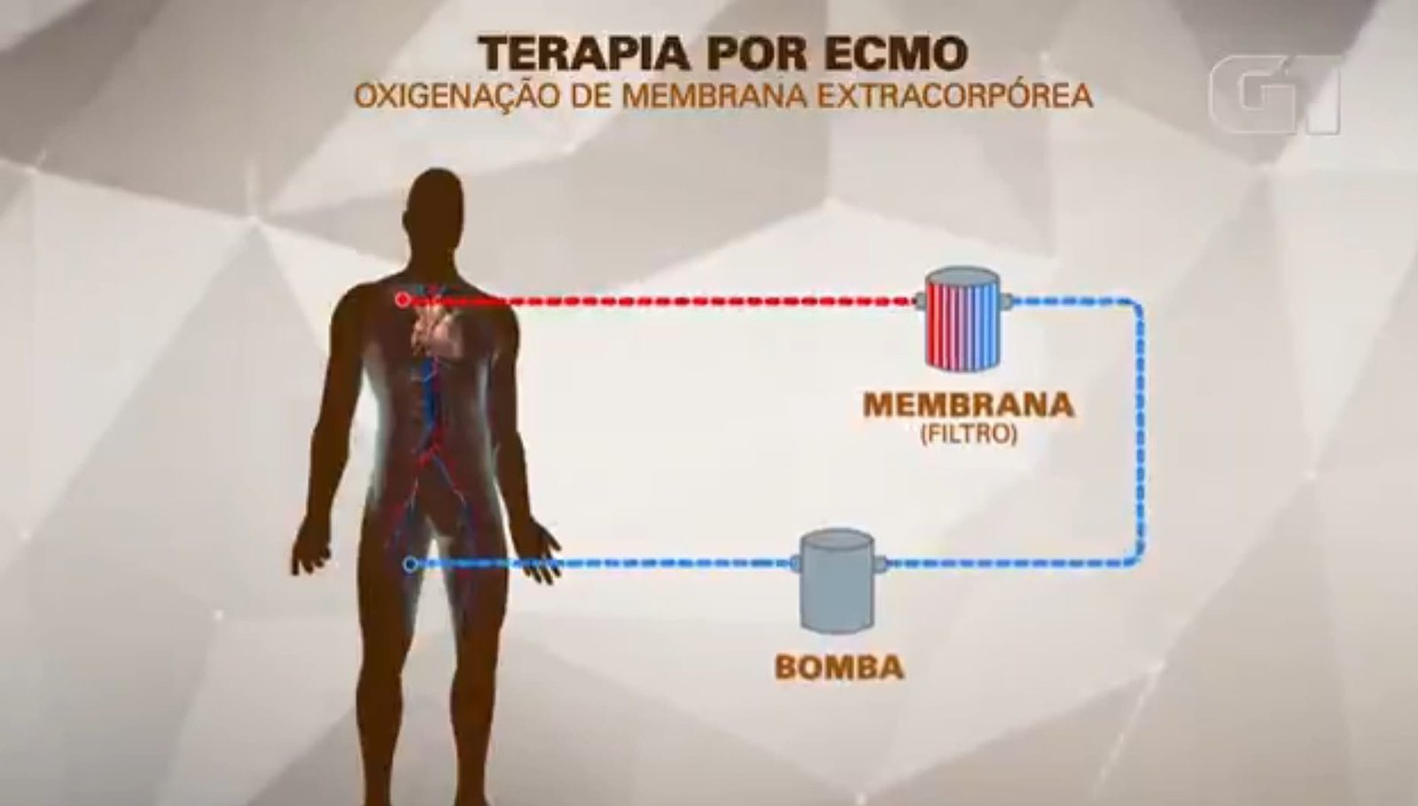 MC Marcinho usa terapia conhecida como ECMO, espécie de pulmão artificial; entenda como funciona