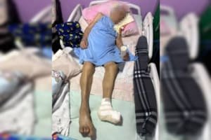Idosa de 103 anos tem pé amputado sem anestesia e com bisturi cego no DF