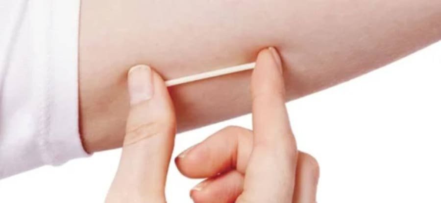 Implante contraceptivo hormonal será oferecido pelo SUS