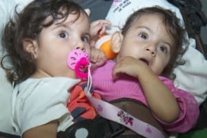 Irmã de siamesa que morreu após cirurgia de separação está sedada em estado grave, diz hospital