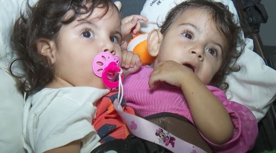 Irmã de siamesa que morreu após cirurgia de separação está sedada em estado grave, diz hospital