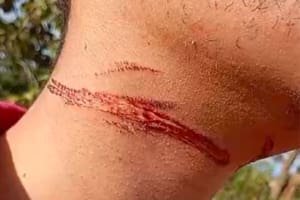 Jovem sofre acidente causado por fio de telefone solto na via
