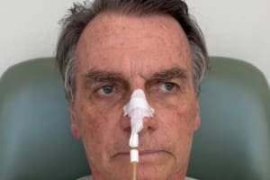 Bolsonaro retira sonda nasogástrica e avança em recuperação da cirurgia abdominal