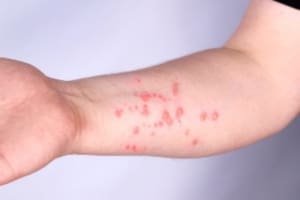 Prefeitura de Aparecida alerta para os cuidados contra a monkeypox