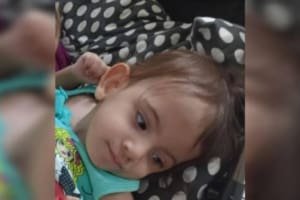 Siamesa Aruna passa por nova cirurgia após separação