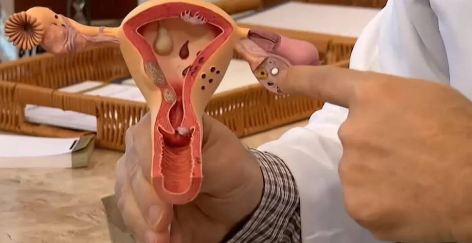 Aberta chamada pública para pesquisas sobre endometriose
