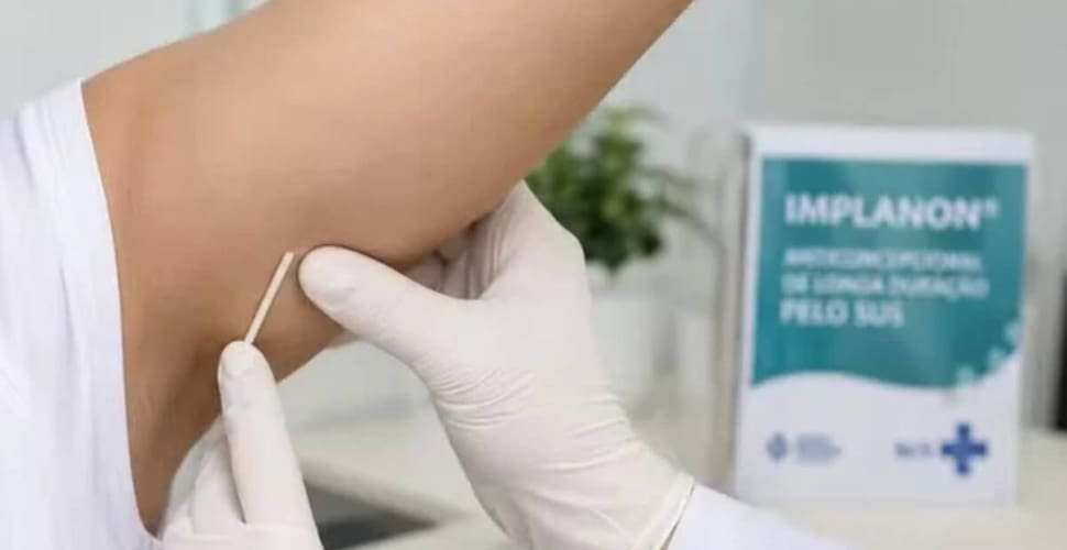 Anvisa amplia para cinco anos validade do implante contraceptivo
